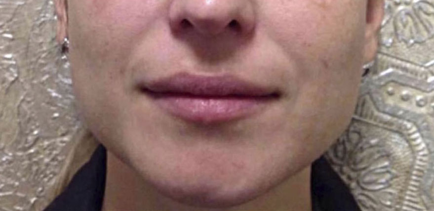 Dermal Fillers Case 72 Before Image