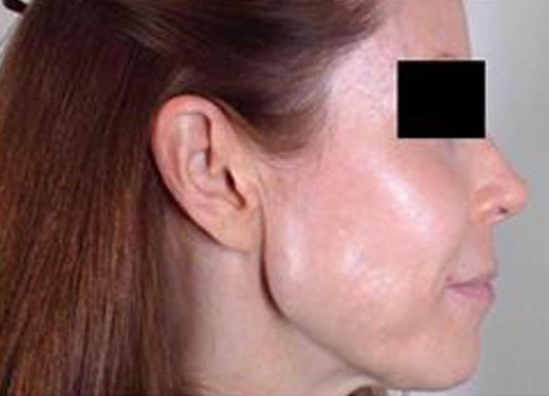 Laser Resurfacing Case 4 After Image