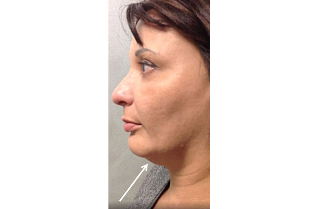 Kybella® Case 3 After Image