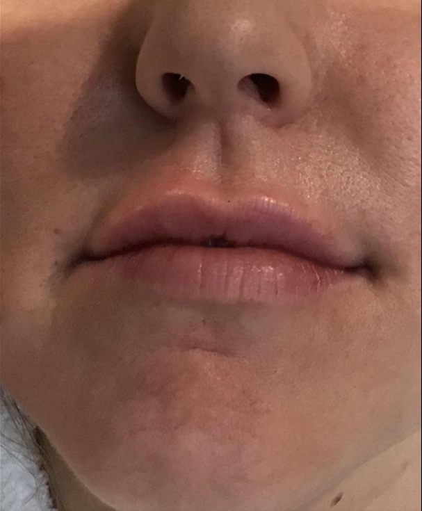 Lip Injections Case 1 After Image
