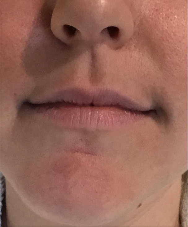 Lip Injections Case 1 Before Image