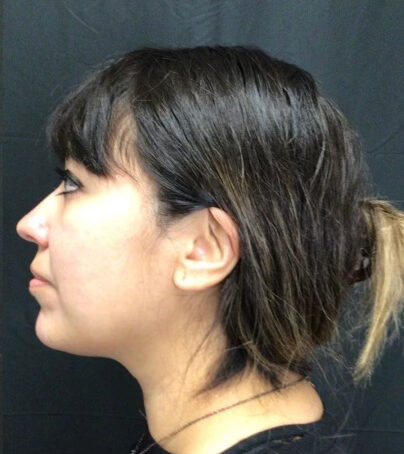 Kybella® Case 4 After Image