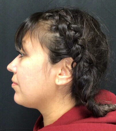 Kybella® Case 4 Before Image
