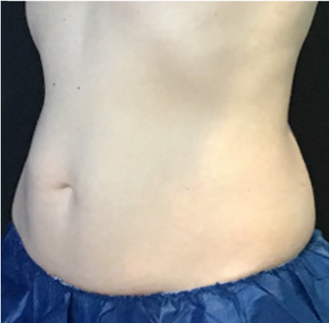 Coolsculpting® ELITE Case 43 After Image