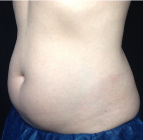Coolsculpting® ELITE Case 43 Before Image