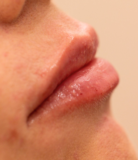 Dermal Fillers Case 68 After Image