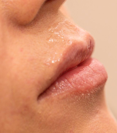 Dermal Fillers Case 68 Before Image