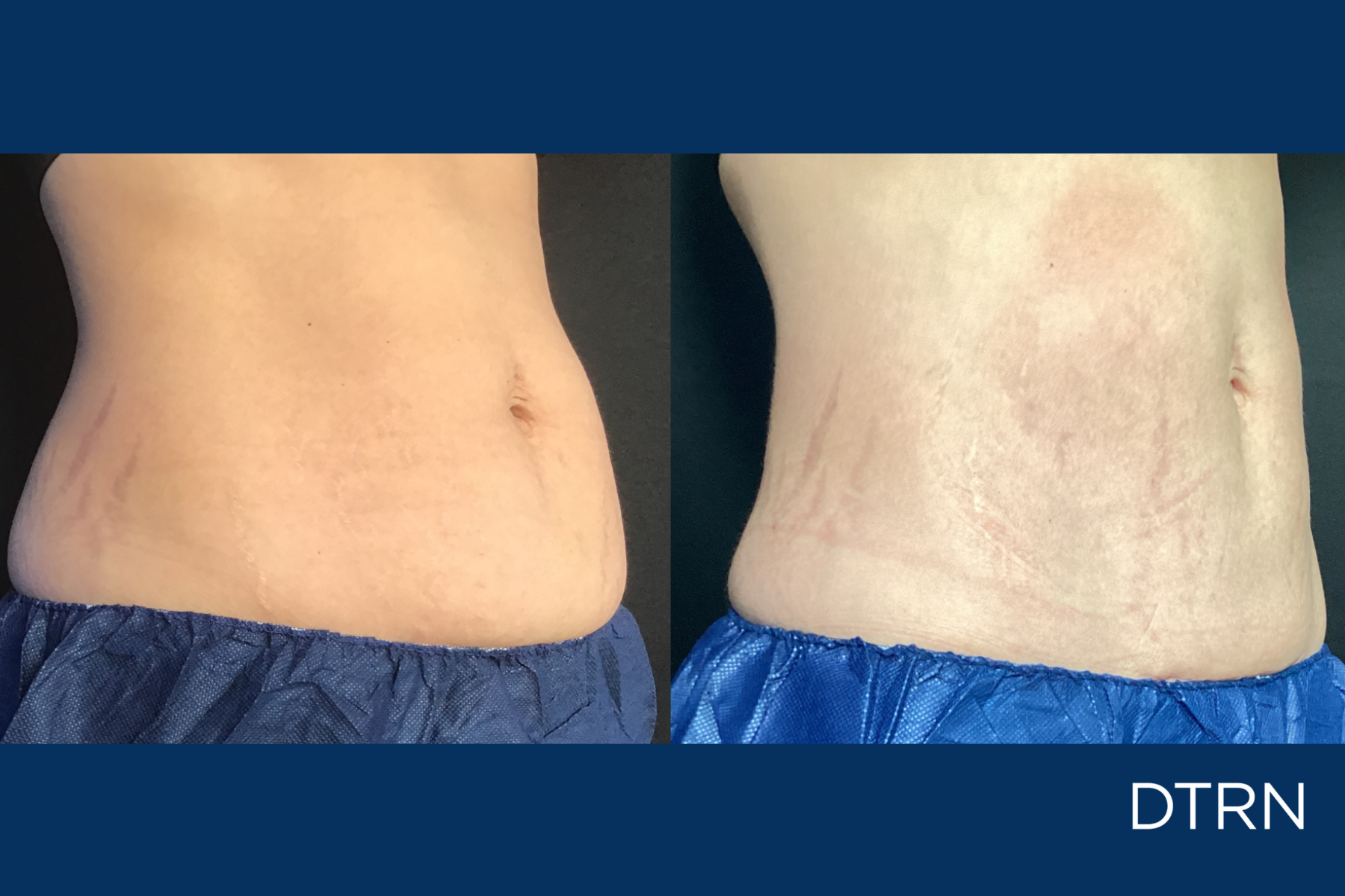 CoolSculpting Houston DermaTouch RN Postpartum Belly Fat