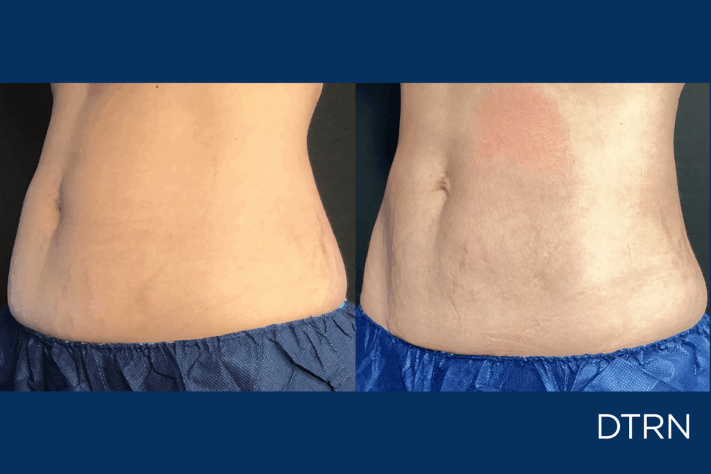 CoolSculpting Houston DermaTouch RN Postpartum Belly Fat