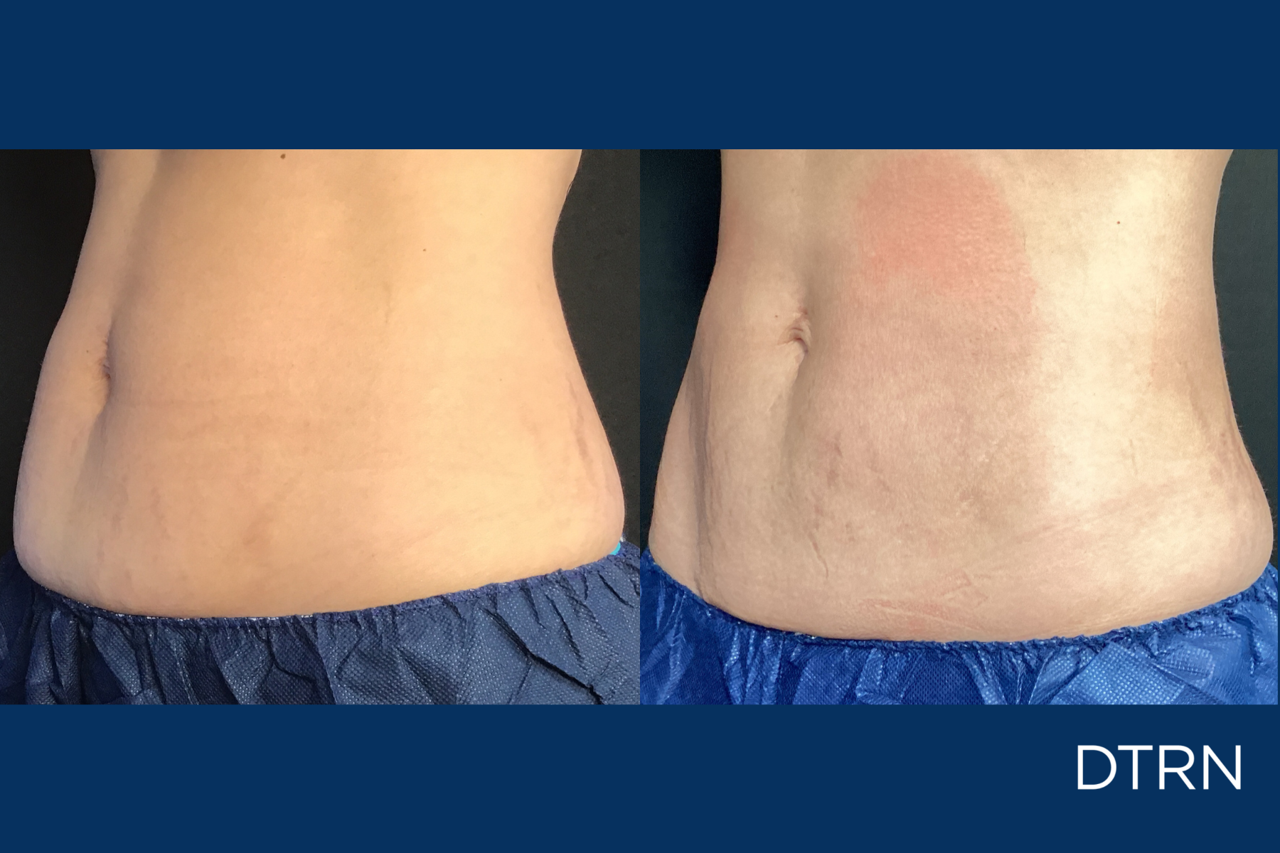 CoolSculpting Houston DermaTouch RN Postpartum Belly Fat