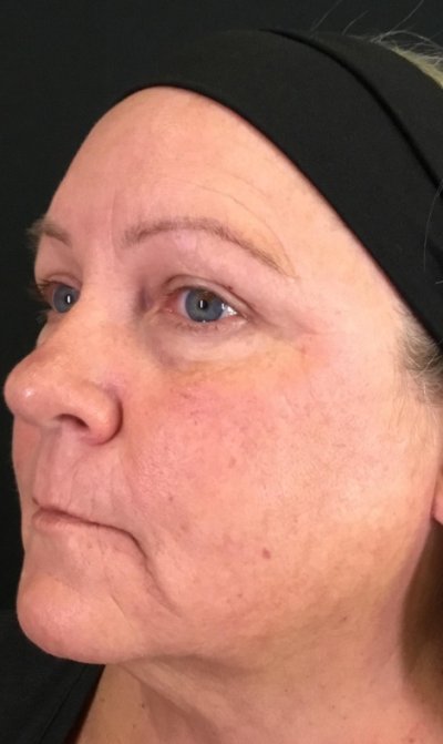 BBL Therapy Halo Combo Case 12 After Image