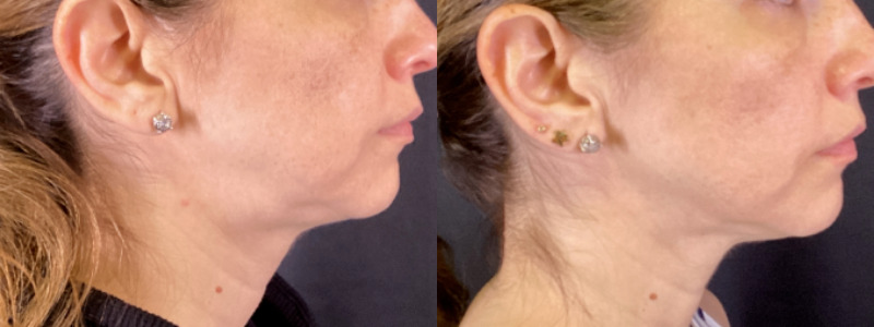 Sofwave™ Case 5 Marge Image