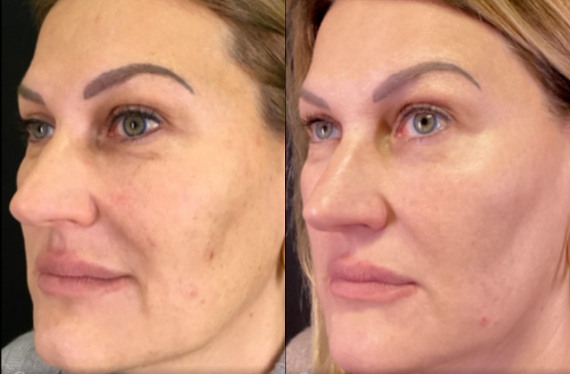 BBL Therapy Halo Combo Case 14 Marge Image