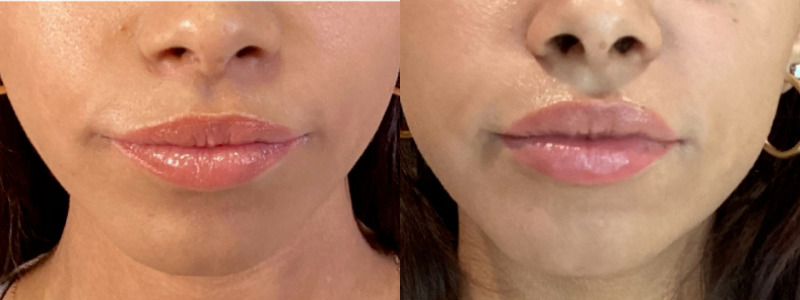 Lip Injections Case 59 Marge Image