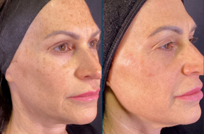 BBL Therapy CoolPeel Combo Case 13 Marge Image