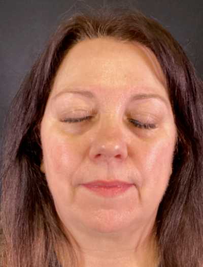 BBL Therapy Case 11 After Image