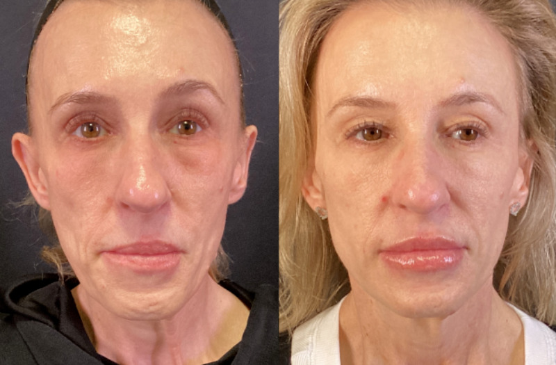 Sofwave™ Case 2 Marge Image