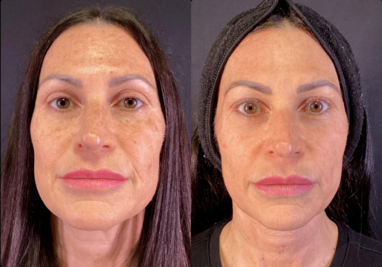 BBL Therapy CoolPeel Combo Case 13 Marge Image