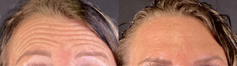 Botox® / Dysport® Case 56 Marge Image