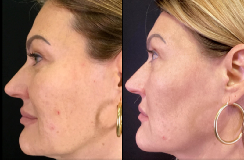 BBL Therapy Halo Combo Case 14 Marge Image