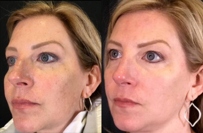 BBL Therapy Case 15 Marge Image