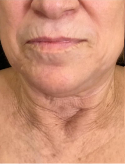 Vivace Case 6 Before Image