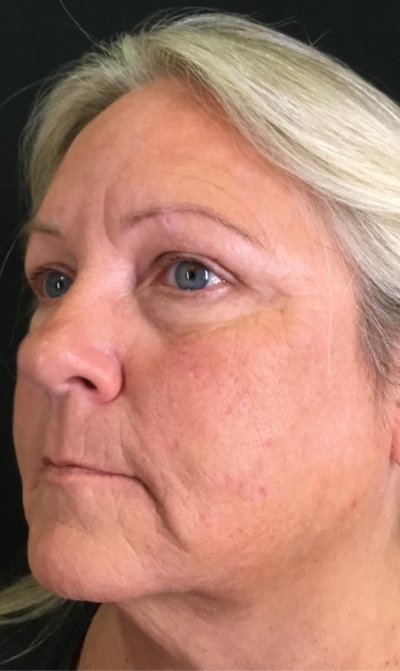 BBL Therapy Halo Combo Case 12 Before Image