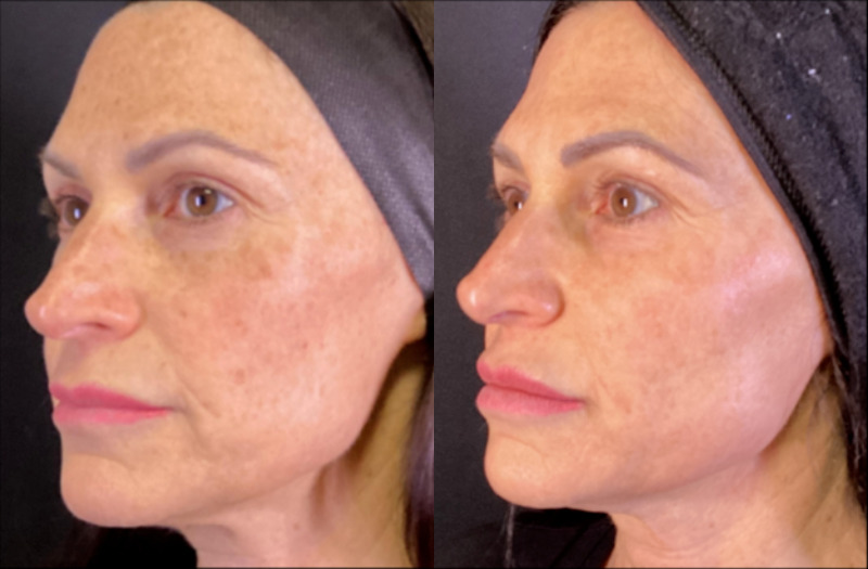 BBL Therapy CoolPeel Combo Case 13 Marge Image