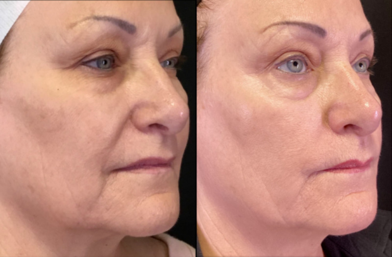 Halo Case 1 Marge Image