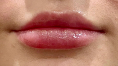 Dermal Fillers Case 72 After Image