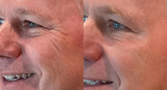 Botox® / Dysport® Case 58 Marge Image