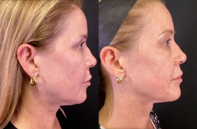 Sofwave™ Case 3 Marge Image