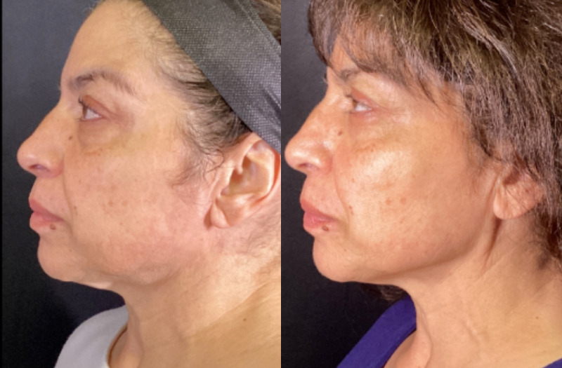 Sofwave™ Case 9 Marge Image