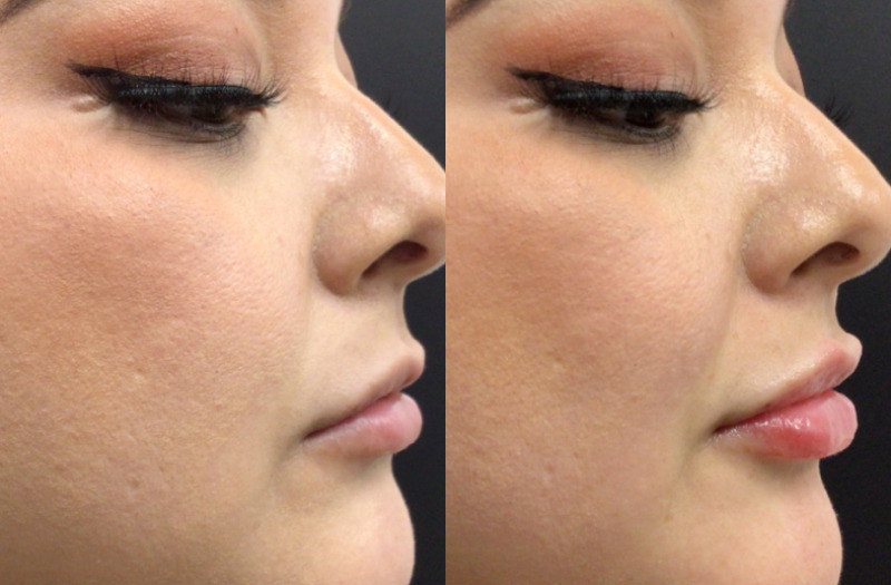 Lip Injections Case 57 Marge Image