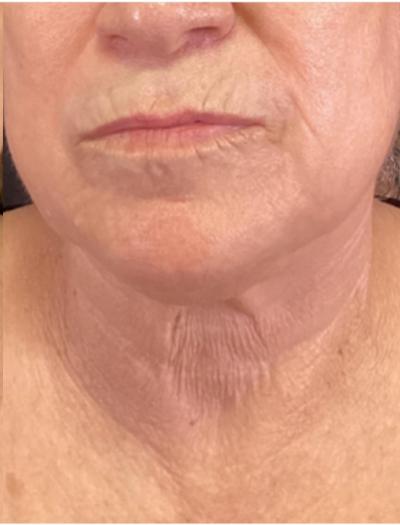 Vivace Case 6 After Image