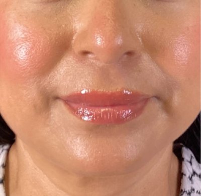 Dermal Fillers Case 73 After Image
