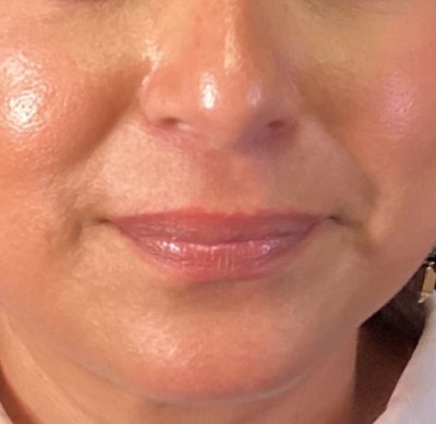Dermal Fillers Case 73 Before Image
