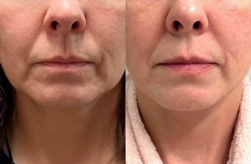 Sofwave™ Case 8 Marge Image