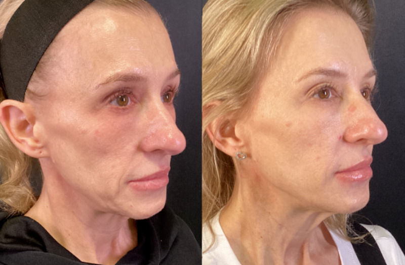 Sofwave™ Case 2 Marge Image