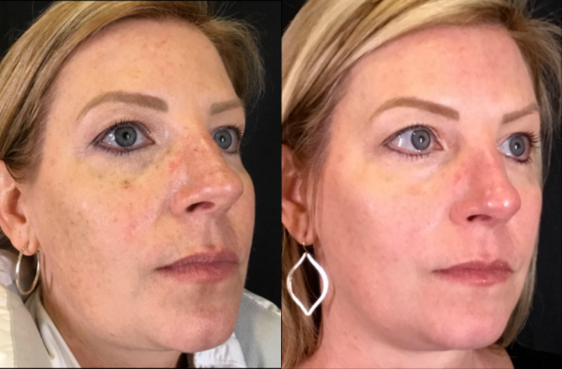 BBL Therapy Case 15 Marge Image