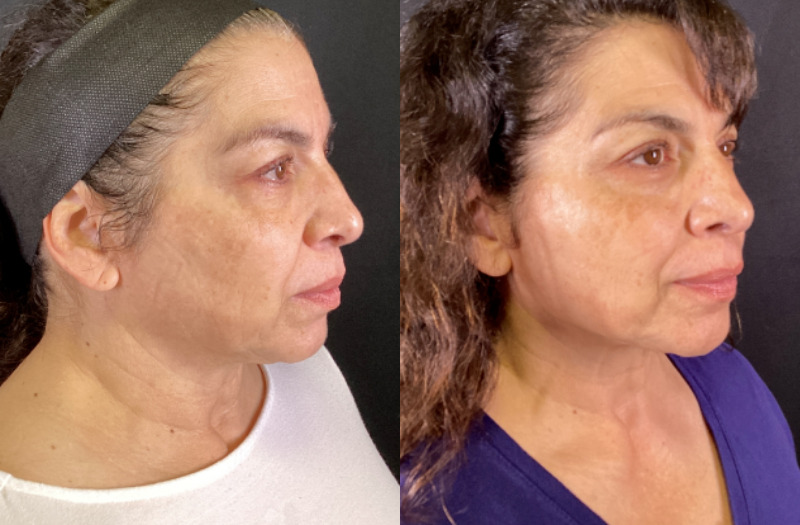 Sofwave™ Case 9 Marge Image