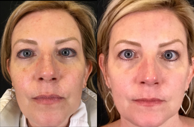 BBL Therapy Case 15 Marge Image