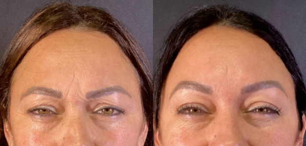 Botox® / Dysport® Case 57 Marge Image