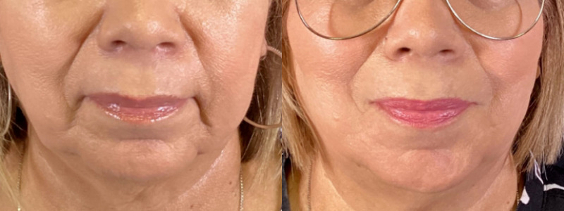 Dermal Fillers Case 74 Marge Image