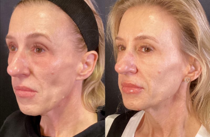 Sofwave™ Case 2 Marge Image