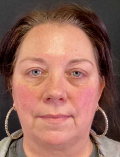 BBL Therapy Case 11 Before Image