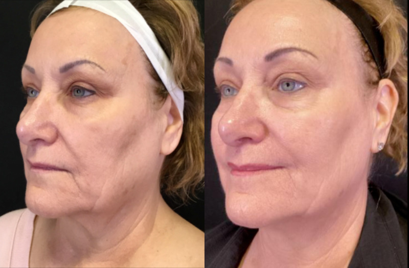 Halo Case 1 Marge Image