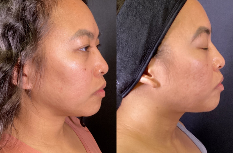 Sofwave™ Case 7 Marge Image