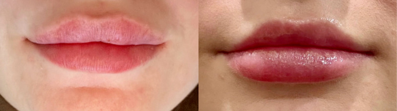 Lip Injections Case 58 Marge Image