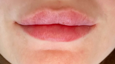 Dermal Fillers Case 72 Before Image